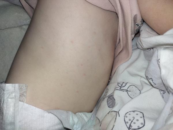 Vyrážka na těle u dvouletého dítěte. Co to může být?