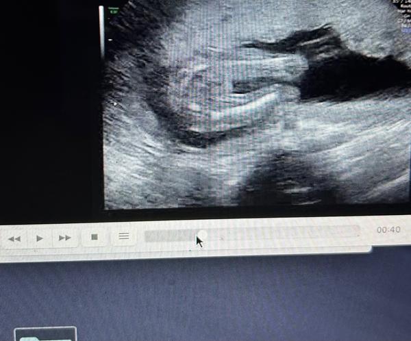 Jaké odhadujete pohlaví ve 22. týdnu těhotenství?