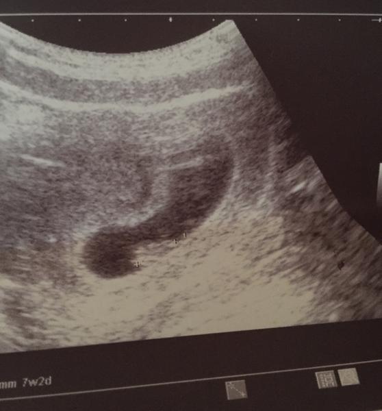 Ultrazvuk. Kolikátý týden podle utz bych mohla být?