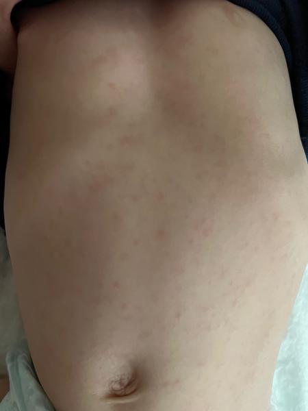 Vyrážka po střevní chřipce. Je to možné? Jak poznám meningokoka od "obyčejné" vyrážky?