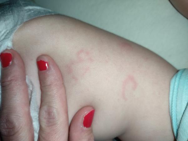Co způsobuje horké fleky na kůži u dcery?