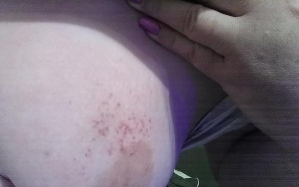 Co způsobuje bolestivou červenou skvrnu na prsu?