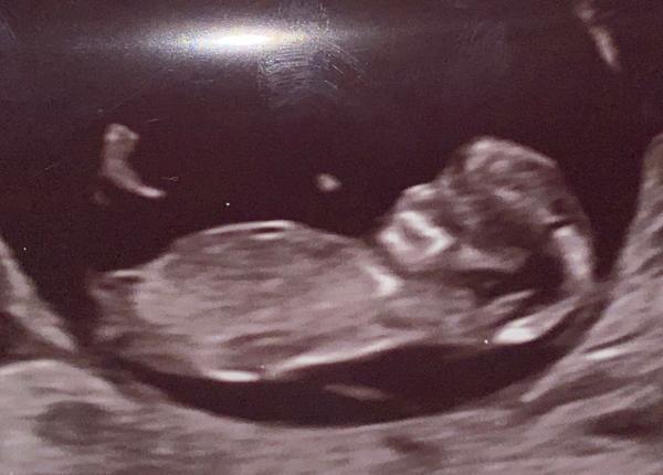 Větší šíjové projasnění. Myslíte, že by se to mohlo ještě do 1. screeningu zlepšit?