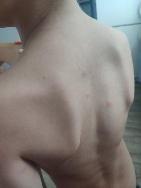 Pupínky u školkového dítěte. Co to může být?