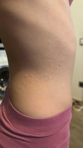 Jak zjistit, zda je vyrážka alergií nebo něčím jiným?