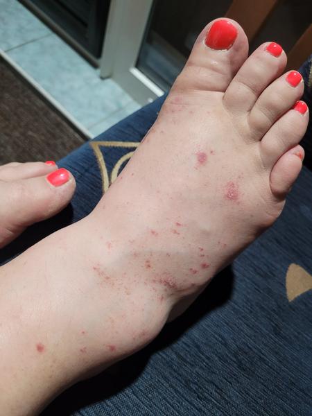 Vyrážka. Nevíte, prosím, co by to mohlo být?