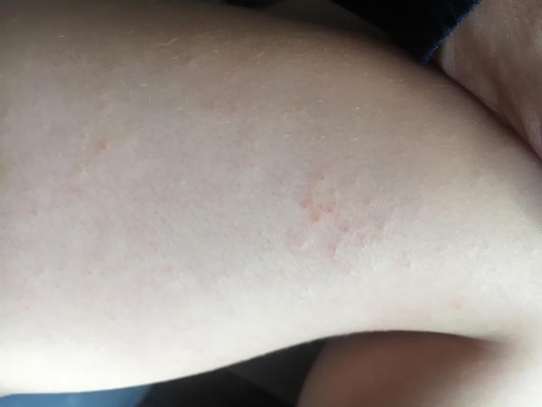 Ekzém u 3 letého dítěte. Hodně se škrábe a kortikoidy nepomáhají. Co více zkusit?