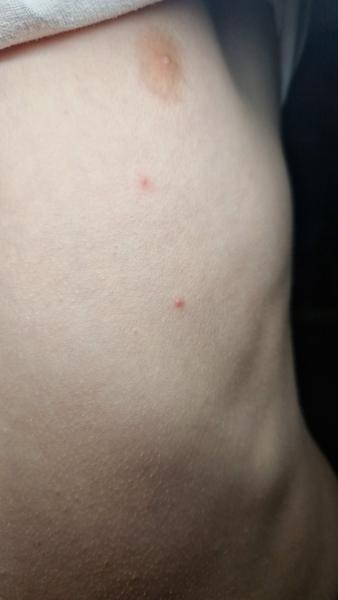 Jsou pupínky po sedmé nemoci běžné?