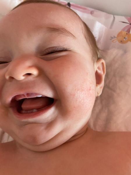 Modřina na dásni u dítěte. Co to může znamenat?