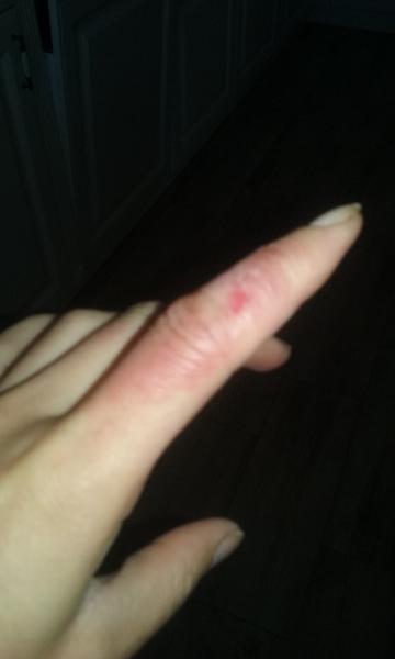 Bolestivé a svědivé prsty: Co způsobuje vyrážku?