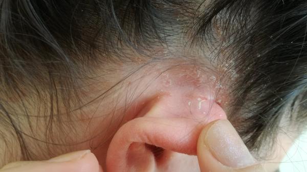 Seborea. Prosím, poradíte?