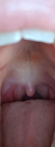 Jak řešit bolest mandlí s bílými tečkami?