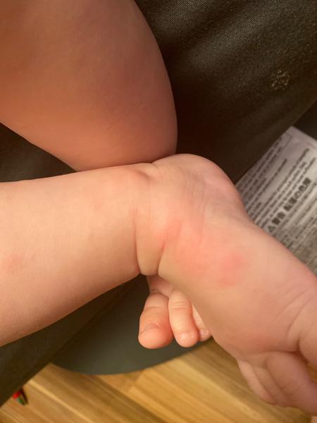 Vyrážka. Co myslíte?