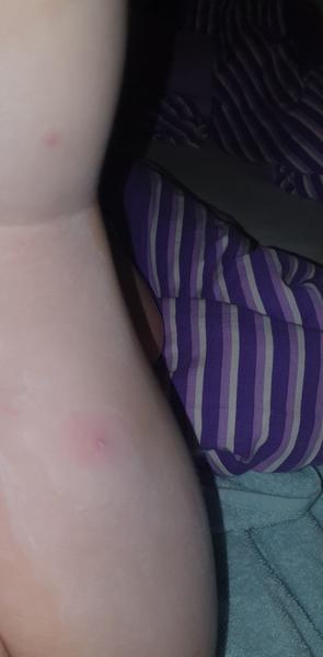 Vyrážka, infekce nebo neštovice. Poradíte, prosím, co by to mohlo být?