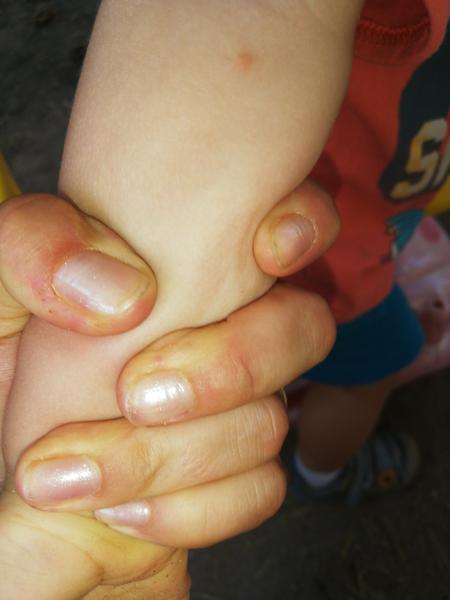 Nevíte prosím někdo, co je to za vyrážku?