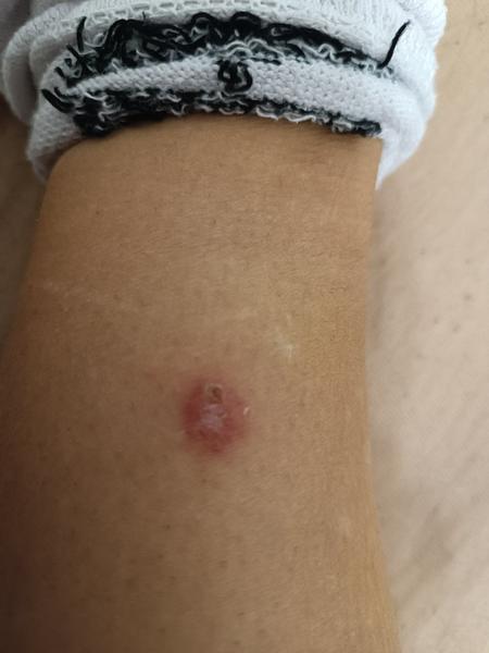 Může to být pásový opar? Jak poznat tuto nemoc?