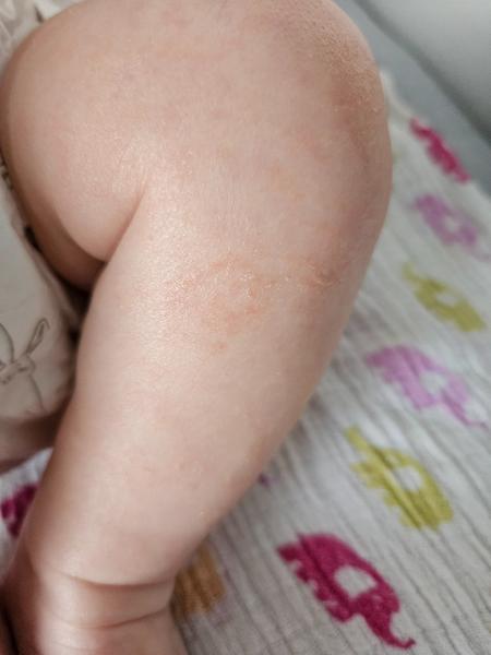 Suchá kůže, ekzém nebo kvasinka?