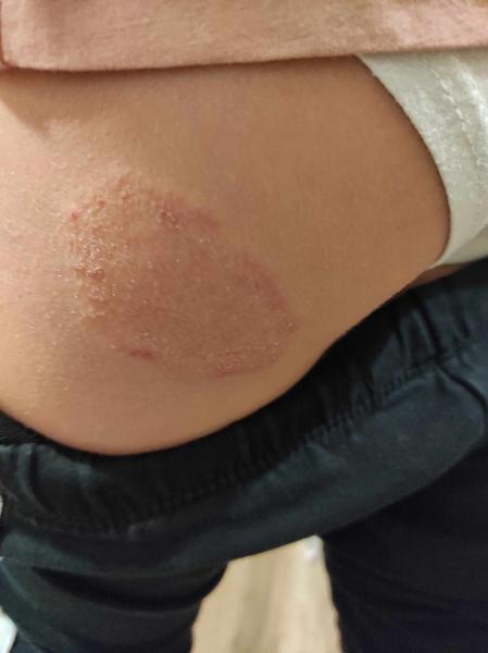 Vyrážka. Nevíte, co by to mohlo být a co by to mohlo značit za problém v těle?