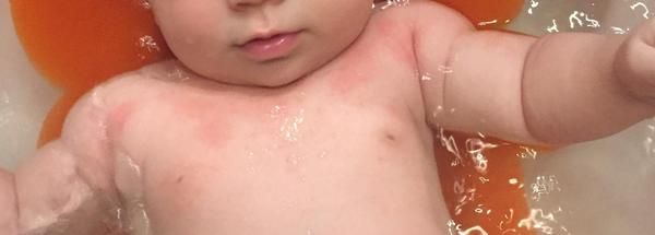 Vyrážka u 3měsíčního miminka . Nevíte, co to můte být?