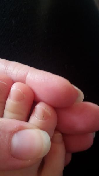 Černá čárka přes nehet na nožicce dítěte. Co to může být?