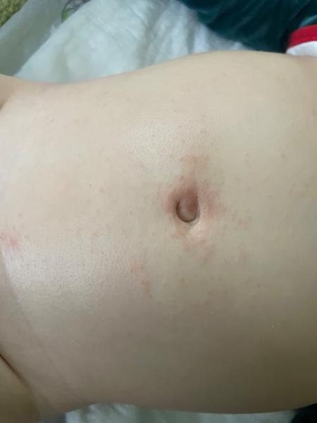 Jak řešit vyrážku u dítěte, pokud mast nepomáhá?