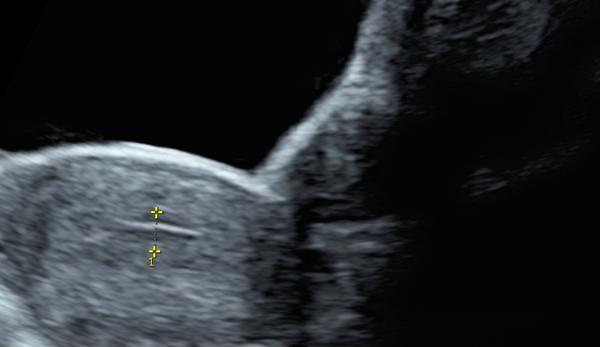 Co znamená čárka na ultrazvuku? Prosím o radu