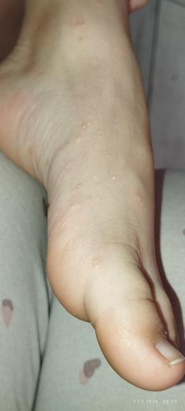 Jak rozpoznat příčinu svědivých pupínků u dětí?