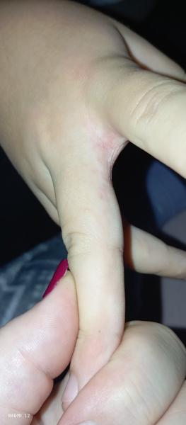 Co způsobuje svědivé pupínky mezi prsty u dcery?