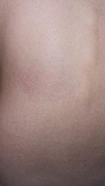 Sklerodermie u dcery. Může to být?