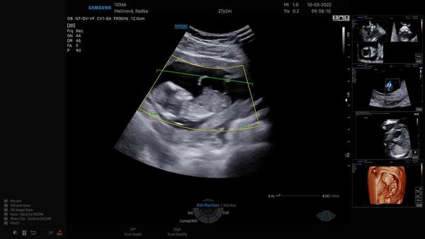 Pohlaví miminka. Nevíte, prosím, co čekáme?