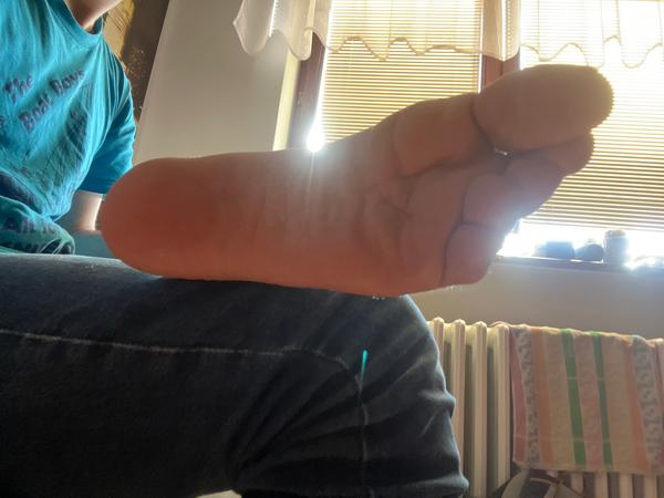 Jak odhalit plochou nohu a mohu ji léčit?