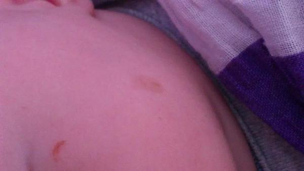 Flíček na tvářičce, co to může být?