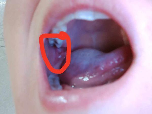 Co dělat při bolesti vrchní osmičky a nachlazení?