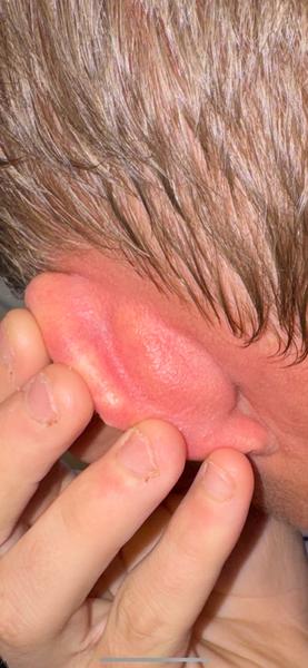 Vyrážka. Co to může být a jak to léčit?