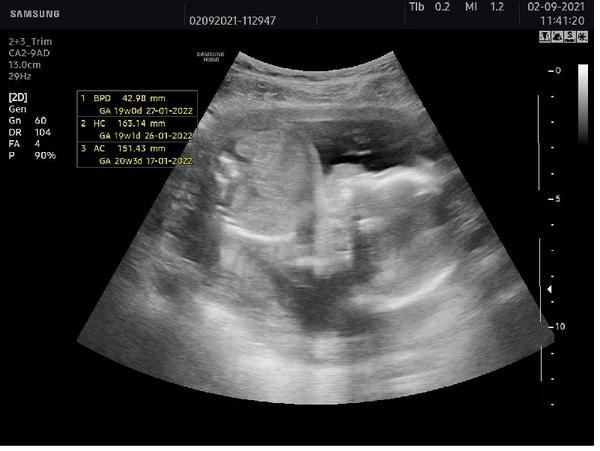 Pohlaví dítěte. Stalo se vám, že by bylo v pozdějším stádium jiné?