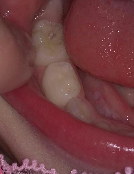 Je to zubní kaz? Rady a zkušenosti maminek