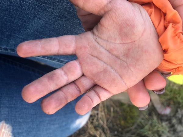 Vyrážka. Co by to mohlo být?