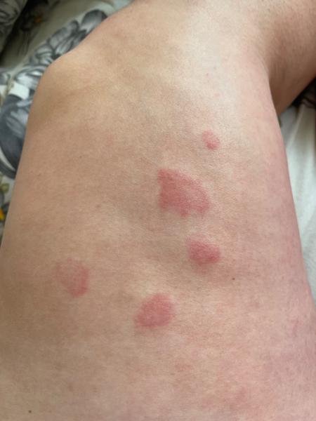 Alergie nebo kopřivka?