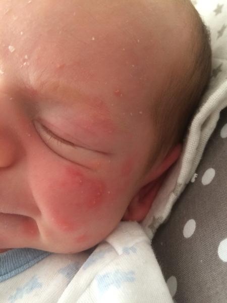 Mohlo by to být novorozenecké akné?