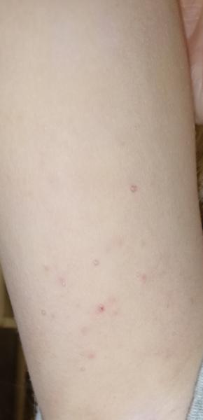 Máte podezření na molusky? Konzultace a doporučení lékařů