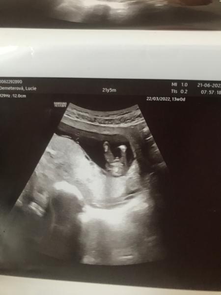 13. týden těhotenství. Lze z těchto fotek určit pohlaví?