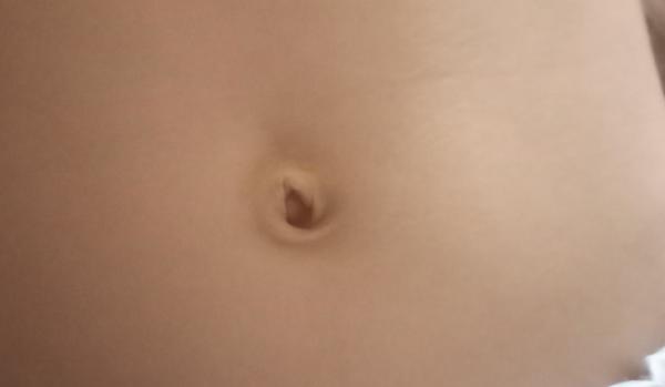 Tejpování a kýlní pás na pupeční kýlu u dětí?