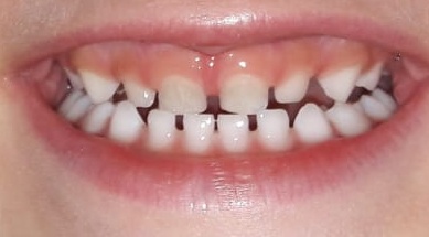 Mramorové zoubky. Co dělat, abychom se zbavili pigmentace?