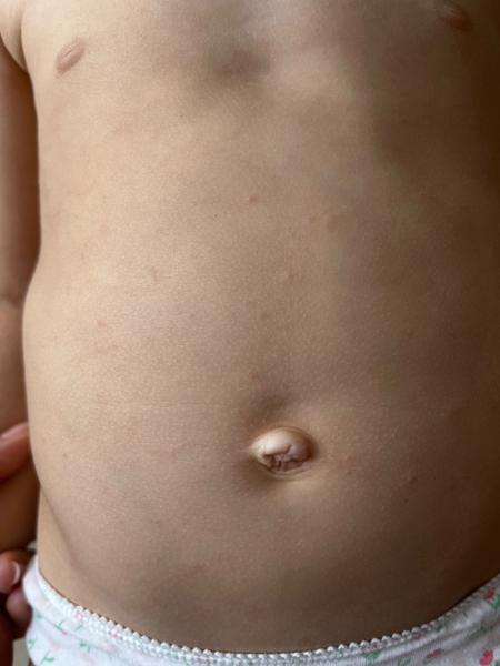 Malé pupínky po celém těle u dítěte. Co dělat?