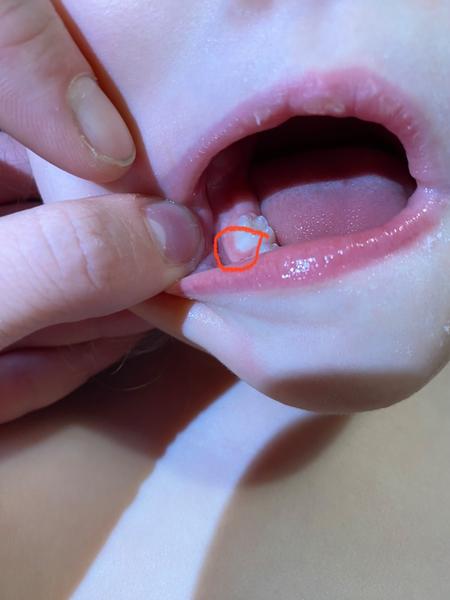 Bílý flíček na zubu u dvouleté dcery. Co dělat?