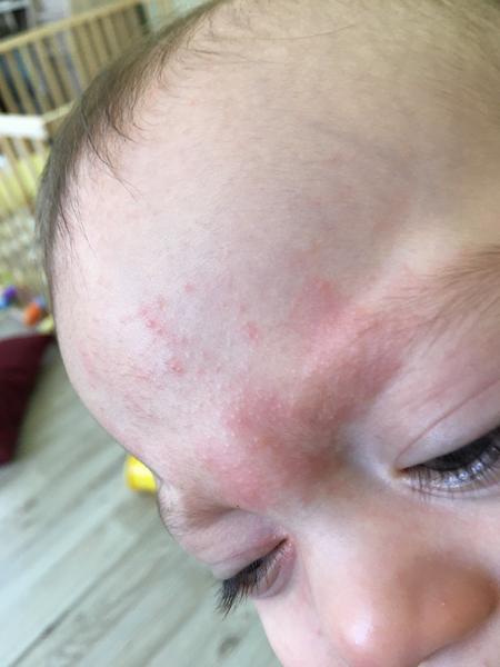 Krupičková vyrážka. Co by to mohlo být? Čím mazat?