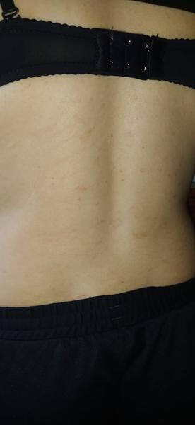 Kožní vyrážka - svědí. Co na ni?