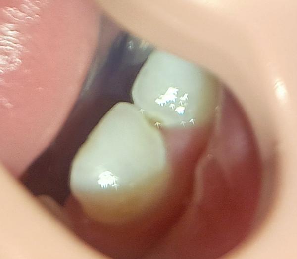 Tmavší flíček a prohlubeň mezi předními zuby. Je to kaz?