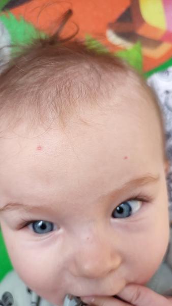 Červené pupínky. Může se jednat o alergickou reakci?