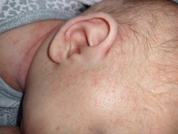 Možné příčiny vyrážky na tvářičce a krku dítěte?